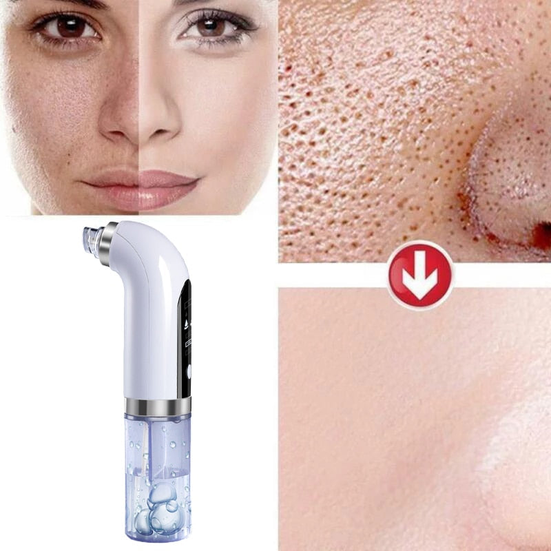LeBelle™ Hydrodermabrasion